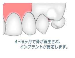 ４～６ヶ月で骨が再生します。