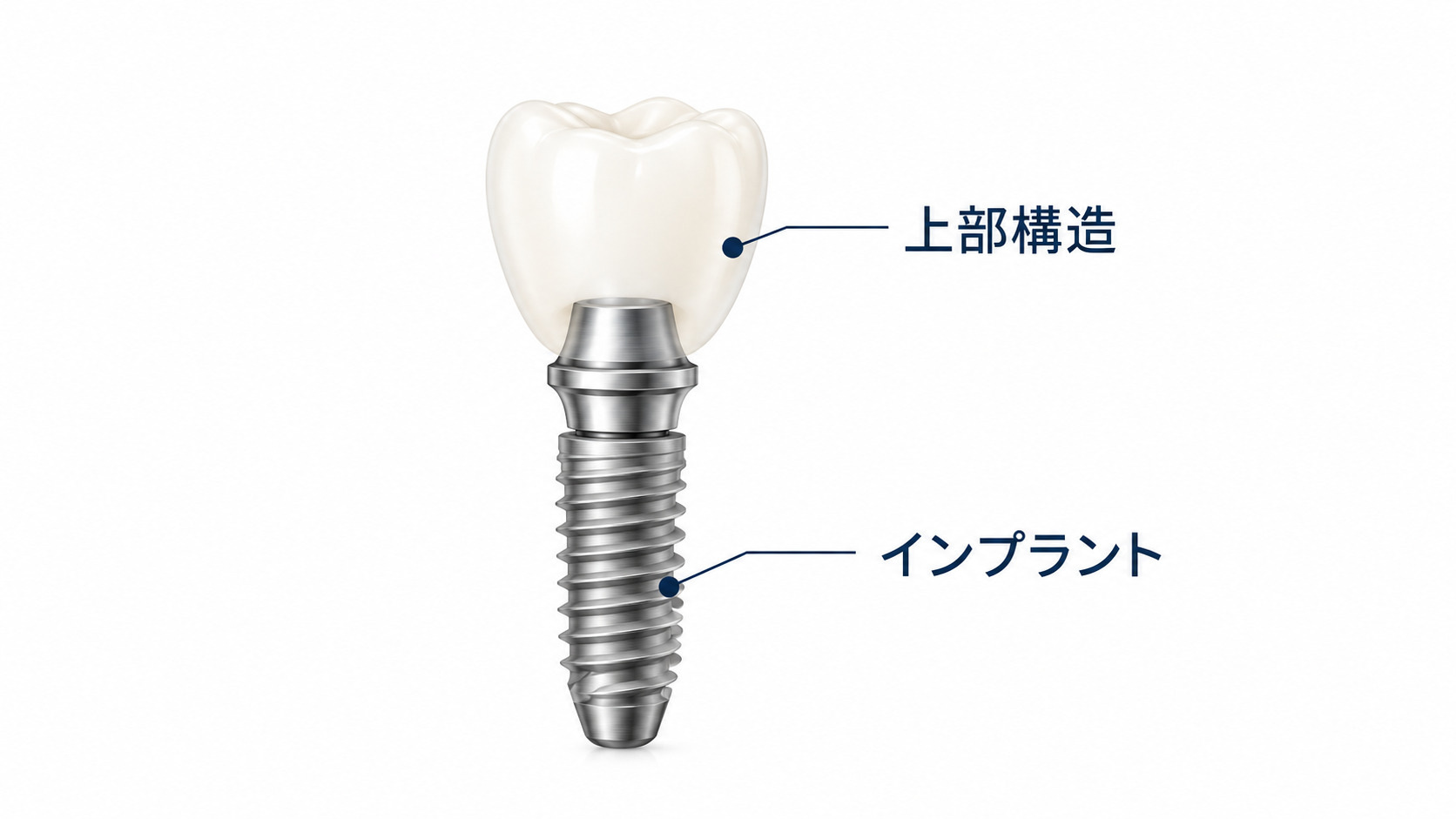 インプラント
