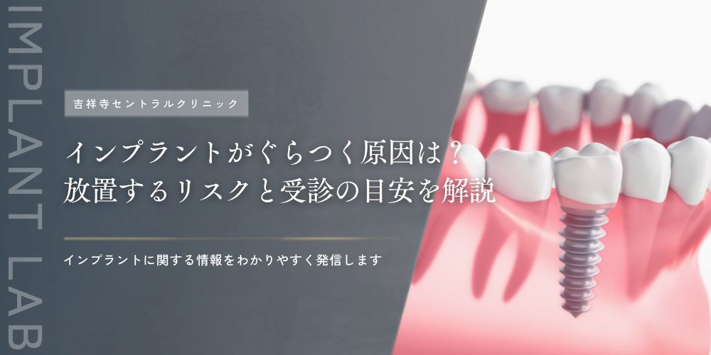 インプラントがぐらつく原因は？放置するリスクと受診の目安を解説