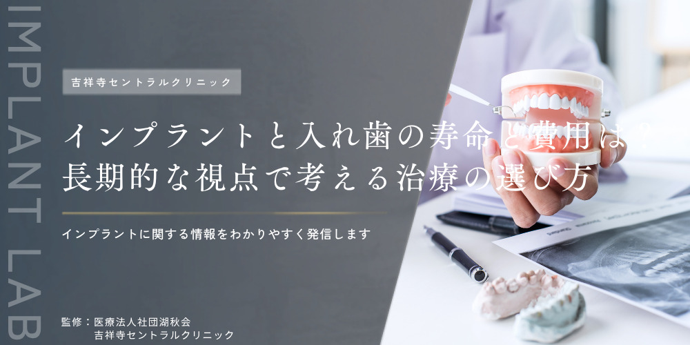 インプラントと入れ歯の寿命と費用は？長期的な視点で考える治療の選び方
