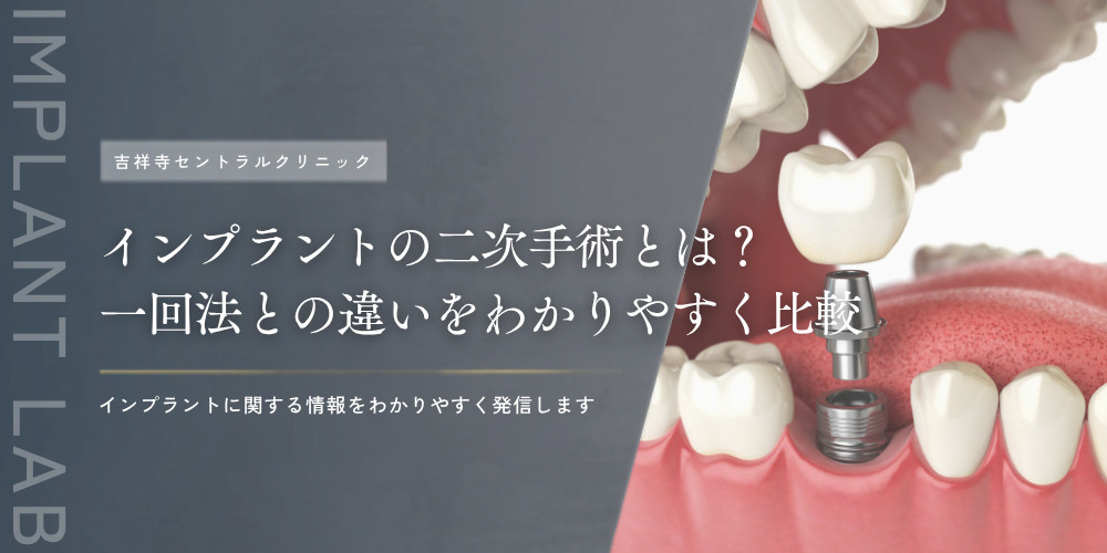 インプラントの二次手術とは？一回法との違いをわかりやすく比較